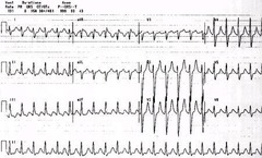 <p>B. amitriptyline</p><p>The answer is B. Antidepressant overdose is the most common cause of suicide by ingestion. Cyclic antidepressants are associated with a higher potential for lethality than other antidepressant medications. Often during the early stages of recovery from major depression, patients may have a "mobilization of energy" which allows them to act on their suicidal thoughts, for which they previously lacked the energy.</p>