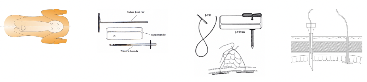 <p><u>+ve:</u> Introduced as improvement on the blind stitch method → Uses litmus paper to test pH of fluid to be certain abomasum is being sutured</p><p><u>Kit:</u></p><ol><li><p>Trocar/canula</p></li><li><p>Nylon handle</p></li><li><p>Suture push rod</p></li><li><p>Suture</p></li></ol><p></p>