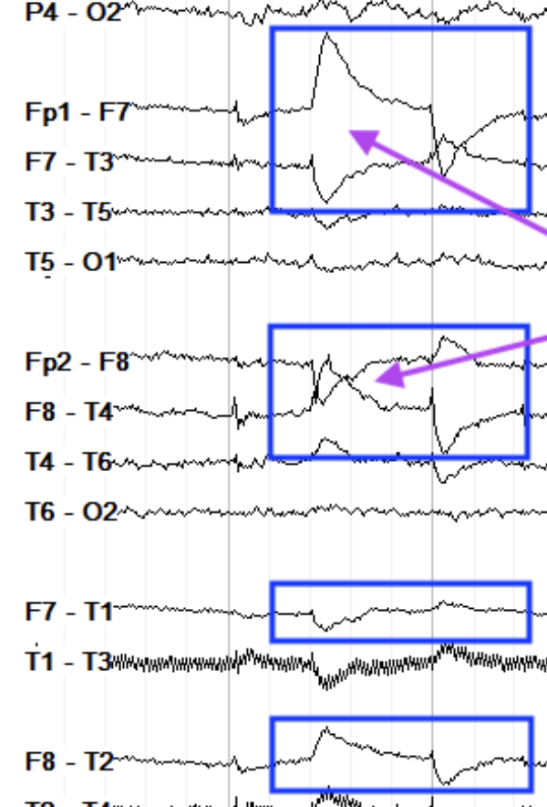 <p>left OR right eye movements, opposing bifrontal regions(lateral eye mvmt)</p>