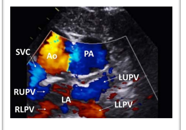 <p>Follow the veins entering atrium and use color flow to show drainage in SSN Short axis •</p><p> Lower color scale</p>