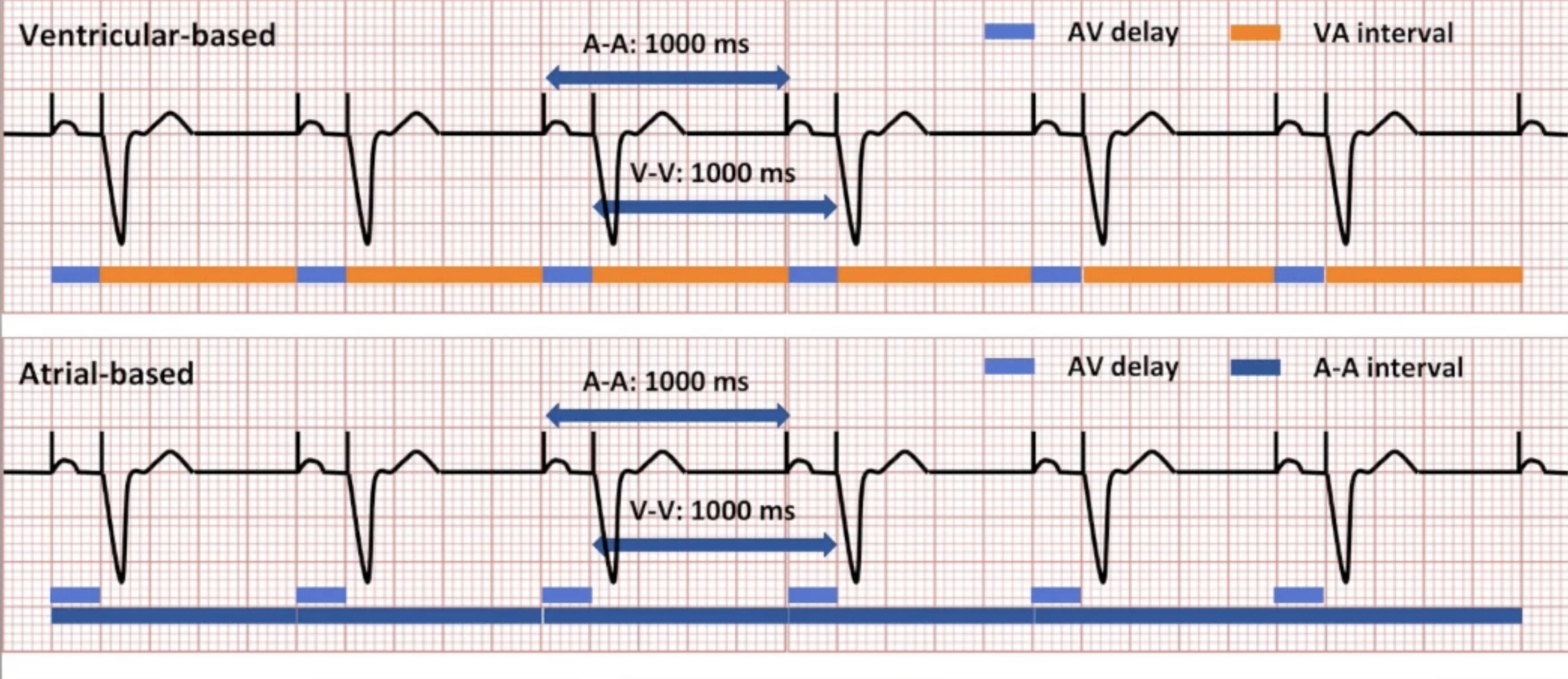 <p>Ventricle-based vs Atrial-based AP/VP diagram</p>