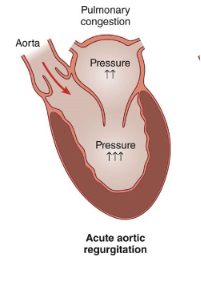 <p>What is aortic regurgitation? </p>