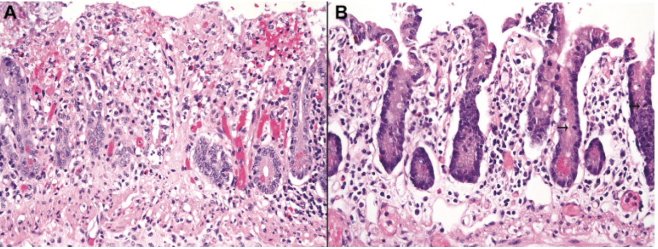 <p>caractéristiques histologiques d’une colite ischémique </p>
