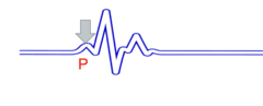 <p>What would cause abnormalities in a P wave?</p>