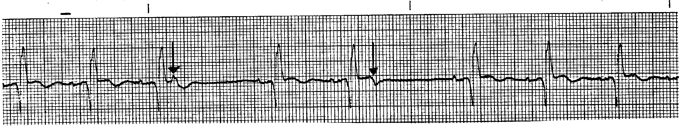 <p>What ECG is this? </p>