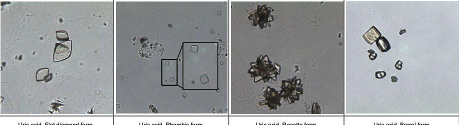 <p>Uric acid crystal</p>