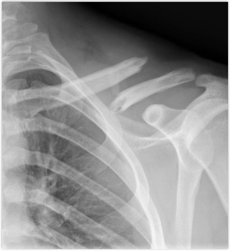 <p>how does a clavicle fracture occur?</p>