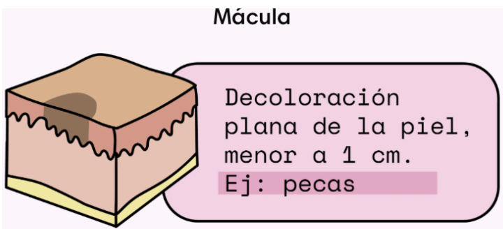 <p><strong>MÁCULA:</strong></p><p class="p1">-Área plana, no elevada o deprimida que</p><p class="p1">presenta cambio de color.</p><p class="p1">-La arquitectura o anatomía del área no</p><p class="p1">está cambiada.</p><p class="p1">-A las maculas si se les escriben bordes</p><p class="p1">A la hora de describirlos se dice antes</p><p class="p1">que después</p>