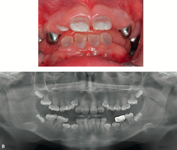 <p>discoloration results from <span style="color: red;">abnormal dentin showing through translucent enamel</span></p><ul><li><p><strong>clinical features:</strong></p><ul><li><p>discolored teeth → <span style="color: red;">blue-gray or yellow-brown</span></p></li><li><p>prone to <span style="color: red;">rapid wear, breakage, loss</span></p></li></ul></li><li><p><strong>radiographic findings:</strong></p><ul><li><p>pronounced <span style="color: red;">cervical constriction at the CEJ</span></p></li><li><p><span style="color: red;">small root</span> structures that may appear:</p><ul><li><p><span style="color: red;">sharp &amp; tent peg-like</span></p></li></ul></li></ul></li></ul><ul><li><p><strong>management:</strong></p><ul><li><p>once significant enamel loss and rapid attrition begin:</p><ul><li><p><span style="color: red;">full-coverage crowns</span> → treatment of choice</p></li></ul></li></ul></li></ul><p></p>