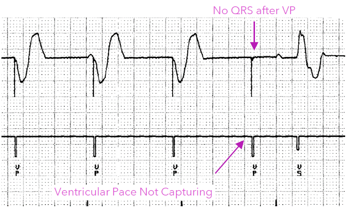 <p>when a pacing stimulus is delivered but does not depolarize the myocardium</p><p>A pacing spike without subsequent myocardial depolarization (failure to capture) can be identified on the surface ECG </p>