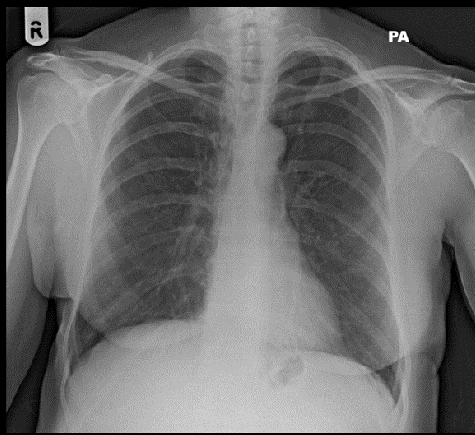 <p><span>Female. 64 Years. Non-smoker. Persistent cough</span><br><span>for one month. Otherwise well</span><br></p>