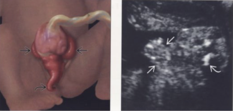 <ul><li><p>absence of normal bladder</p></li><li><p>lower abdominal defect</p></li><li><p>herniation of bowel between halves of bladder</p></li><li><p>omphalocele</p></li></ul><p></p>