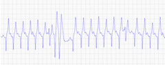 <p>Describe this ECG during exercise</p>