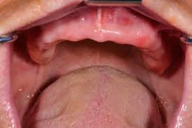 <p>ausencia total/ parcial de dientes por fallo en formación de lámina dental</p>