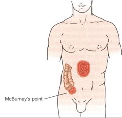 <p>Tenderness location for diagnosing appendicitis.</p>