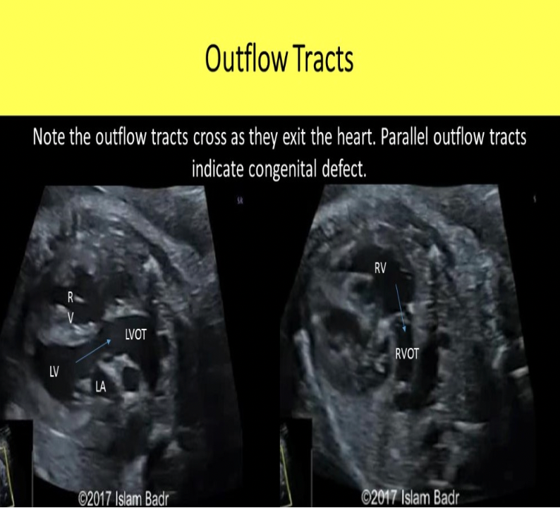 <p>C. ascending aorta, pulmonary artery</p><p>On a fetal ultrasound the LVOT refers to the ascending aorta and the RVOT refers to the pulmonary artery. In pediatric and adult echocardiography, the LVOT refers to the portion of the left ventricle just proximal to the aortic valve and the RVOT refers to the portion of the right ventricle just proximal to the pulmonary valve.</p>