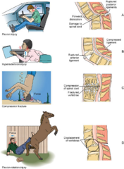 <p>unstable (not all fx are unstable, if ligament damaged, bones can be unstable)</p><p>suspicion of secondary injury is high, with a more significant presentation (e.g. high velocity MVA, fall of significant height)</p>
