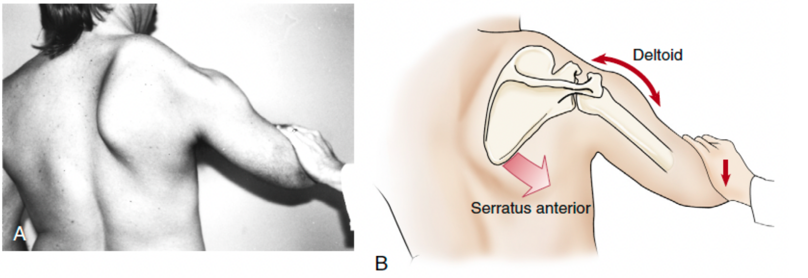<p>describes when the scapula is not held down against the thorax</p><p>visible when the medial border lifts up off the trunk </p>