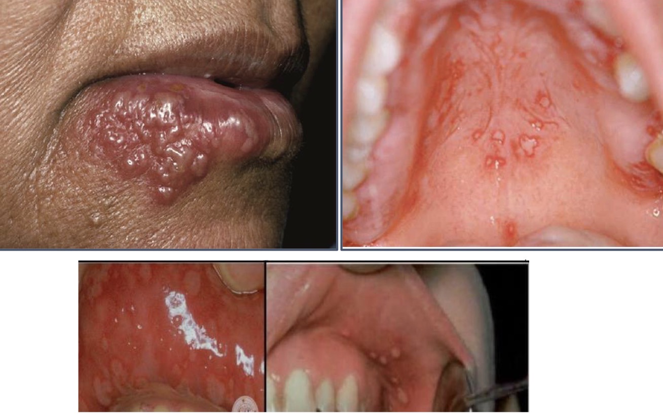 <p>Infection of oral cavity by HSV 1</p><p>Under 6 yrs- sometimes adolescents and adults</p><p>Small spherical grey vesicles, after 24hrs painful ulcers with raised red margin, yellow central portion</p><p>Painful, avoid hot foods, lasts 7-10days</p><p>Oral mucosal soft palate, pharynx, floor of mouth, tongue, sublingual area</p><p><strong>Antivirals- shorten duration and severity, </strong>antipyretics, systemic analgesics and analgesic mouthwashes</p>