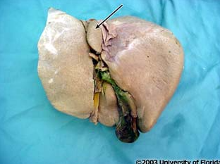 <p>what lobe of the liver is this?</p>