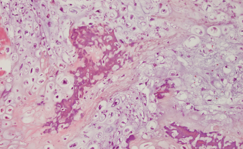 <p>Lésion diaphisaire du fémur, sous périosté homme de 20 ans </p><p>Diagnostic</p><p>Définition</p><p>Age</p><p>Topographie</p><p>Anatomie</p><p>Histologie</p><p>Moléculaire et IHC </p>