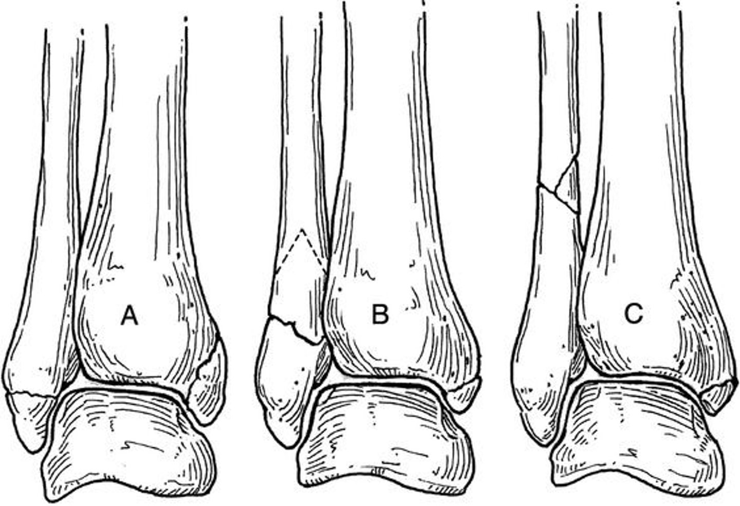 <p>DANIS WEBER - Describes location of fibular fracture.</p><p>Type A - transverse avulsion fracture below the level of the ankle joint</p><p>(corresponds with Lauge-Hansen SAD)</p><p>Type B - spiral or oblique fracture at the level of the ankle joint</p><p>(corresponds with Lauge-Hansen SER and PAB)</p><p>Type C - fracture above the level of the ankle joint (Maisonneuve fracture)</p><p>(corresponds with Lauge-Hansen PER)</p>