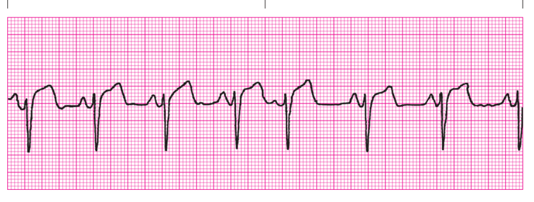 <ol><li><p>Regularity?</p></li><li><p>Rate</p></li><li><p>P Waves</p></li><li><p>PRI</p></li><li><p>QRS</p></li><li><p>Interpretation</p></li></ol><p></p>