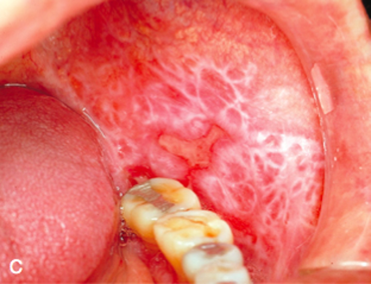 <p>- violaceous, flat topped papules with white streaks (wickham striae)</p><p>- drug/medication induced, Koebner phenomenon, spontaneous</p>