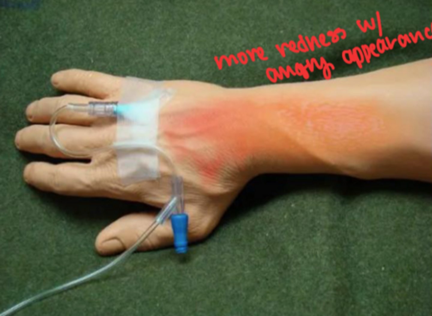 <p>systemic or localized infection because of lack of asepsis or poor continued care of IV</p>