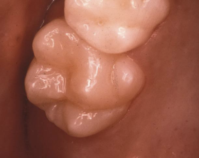 <p>accessory cusp on palatal surface of ML cusp of maxillary molars </p>