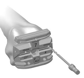 <p>Guides the anterior, posterior, and chamfer femoral cuts.</p>