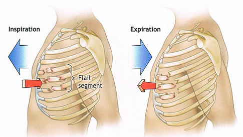 <ul><li><p>palpate for sternum stability</p></li><li><p>observe for paradoxical chest wall motion (flail chest segment)</p></li><li><p>observe for chest wall deformity</p></li></ul><p></p>