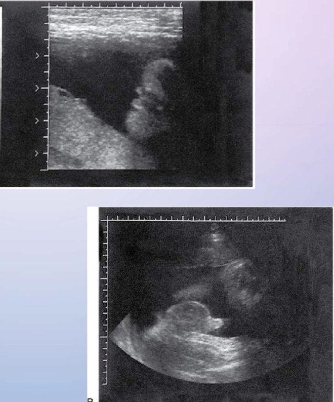 <p>Determination of fetal gender depends on visualization of either male scrotum or female labia; assignment of gender should not be made on basis of presence or absence of a fetal penis</p>