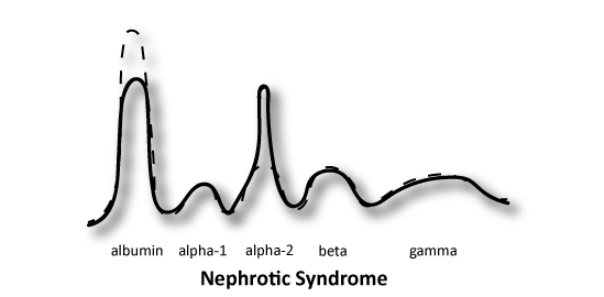 <p>DECREASED albumin</p><p>INCREASED alpha-2</p><p></p><p><strong>ALBUMIN LEAKS, ALPHA 2 STAYS</strong></p>