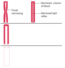 <p>arteries close to the optic disc become full and tortuous developing an increased light reflex with a copper color</p>