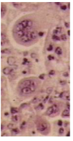 <p><span style="line-height: 16.866667px;">The most common cause of lower respiratory tract infections in young children causes irritation to the bronchiole lining, with the characteristically damaged cellular appearance seen at right. What is this disease?</span></p>