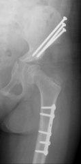 <p>- Failed conservative measures</p><p>- Require big, invasive surgeries</p><p>- But rarely needed</p>