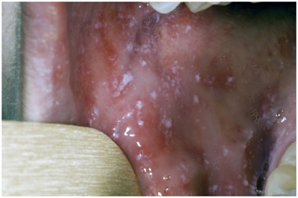 <p>Causative Agent: Morbillivirus virus<br>Symptoms/Signs: Sore throat, Dry cough, Headache, <strong>Koplik’s spots</strong>, Conjunctivitis, Lymphadenitis, Fever, Widespread rash spreading from the head to the trunk and extremities.</p>