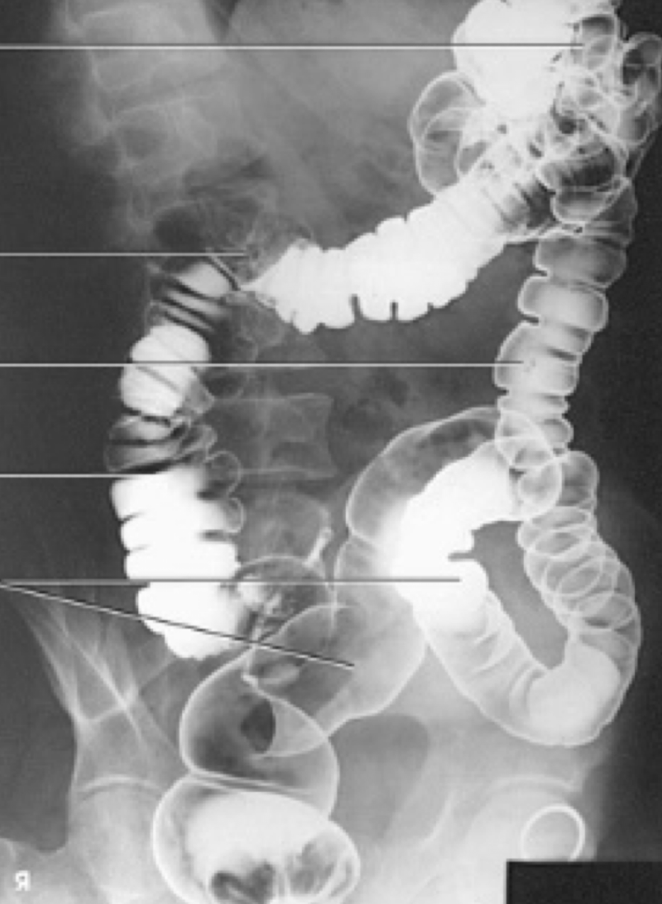 <p>Hepatic (right colic) flexure</p>