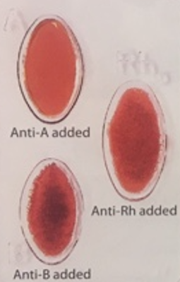 <p>What blood type is this sample?</p>
