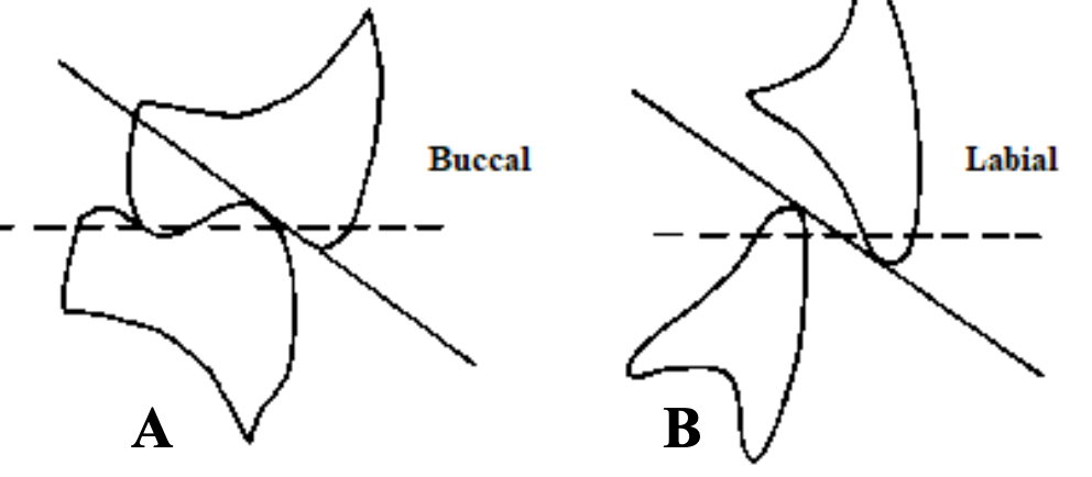 <p>In an CD/RPD case, when are cusped teeth used (Dentsply 33˚)?</p>