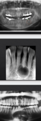 <p>How are these lesions described in terms of size?</p>