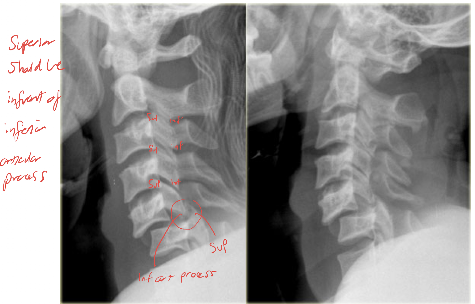 <p>Significant degree flexion and distraction causing ligamentous disruption to extend anteriorly</p><ul><li><p>Extremely unstable condition</p></li><li><p>75% occur between C3 and C7</p></li></ul><p></p>