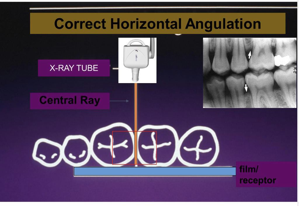 <p>-Central ray should pass between inter-proximal contacts.</p><p>-Central ray is directed toward the center of the bitewing tab (helps prevent cone cuts)</p><p>-Centra tray should be perpendicular to the film/receptor and the buccal surface of the film/receptor.</p>
