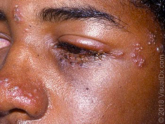 <p>•Ophthalmology consult</p><p>•Antiviral agents</p>