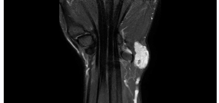 <p>Lipoma or Hemangioma</p><ul><li><p>image is stir demonstrating hemangioma</p></li></ul><p></p>