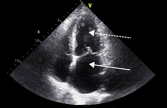 <p>Echocardiography findings for heart failure</p>