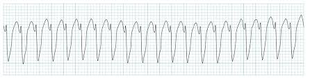 <p>ECG Patterns: VT</p>