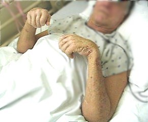 <p>what is flexion contracture, and extension contracture</p>