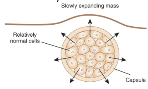 <p>Cell appearance: Relatively normal cells</p><p>Replication: high replication rate but controlled</p><p>encapsulation: encapsulated</p><p>invasion: does NOT penetrate nearby tissues</p><p>Metastasis: low likelihood</p>